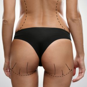Back side of young female body with marks for fat transfer Brazilian Butt Lift