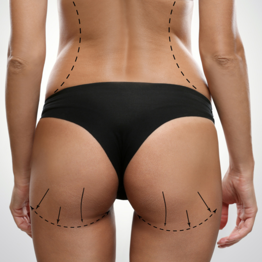 Buttock augmentation and reshaping with own fat tissue - Aesthetic