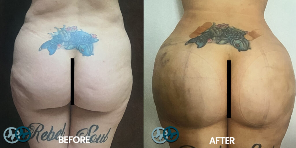 Before and After BBL_Dr Nees Delray Beach