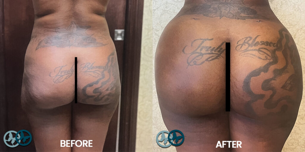 Before and After BBL_Dr Nees Delray Beach