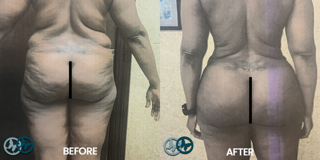 Before and After BBL_Dr Nees Delray Beach