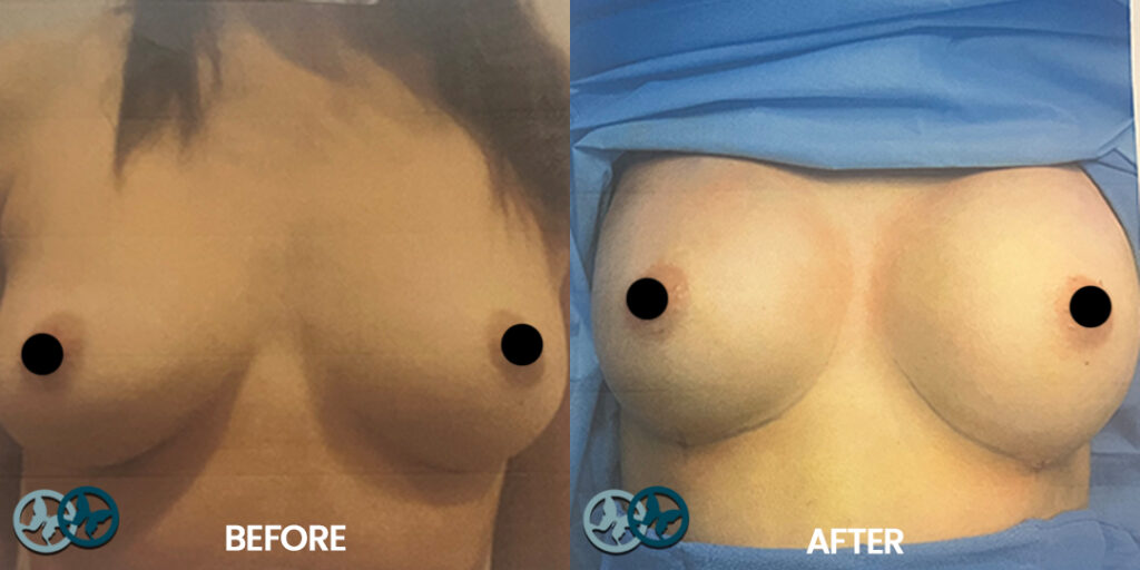 Before and After Breast Aug_Dr Nees Delray Beach