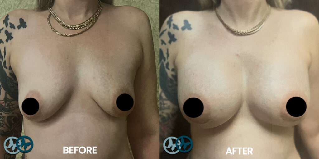 Before and After Breast Augmentation_Dr Nees Delray Beach