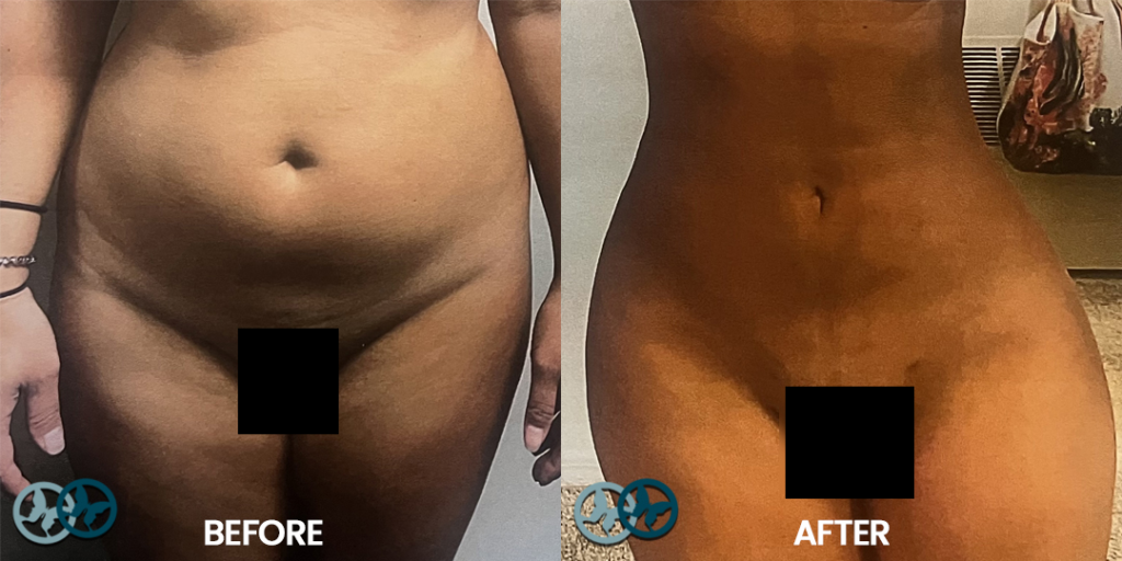 Before-and-After-Lipo-360_Dr-Nees-Delray-Beach