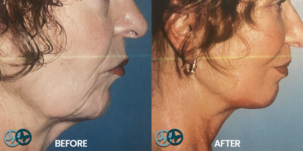 Before and After Necklift_Dr Nees Delray Beach