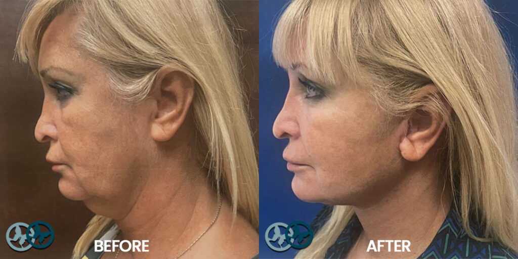 Before and After Necklift_Dr Nees Delray Beach