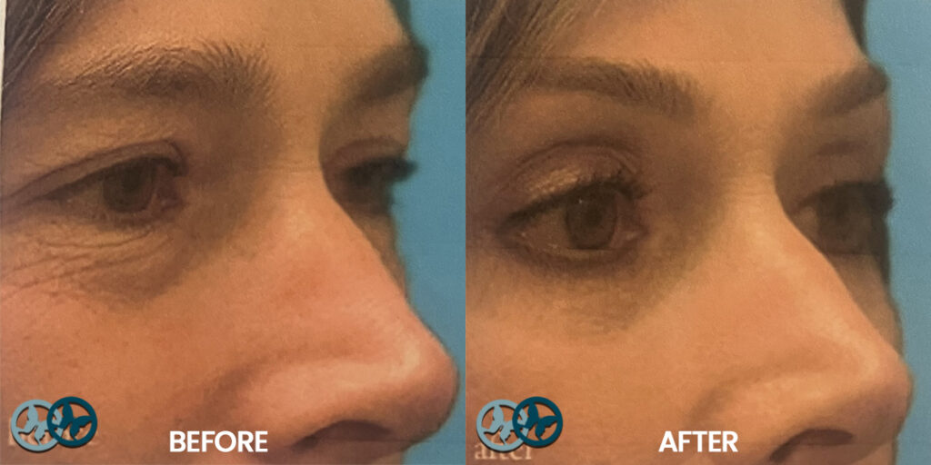 Before and After Quad Blepharoplasty_Dr Nees Delray Beach