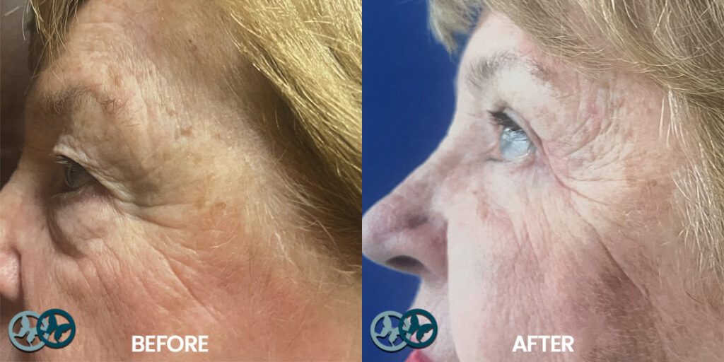 Before and After Quad Blepharoplasty_Dr Nees Delray Beach