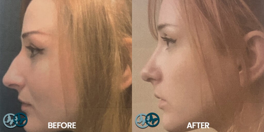 Before and After Rhinoplasty_Dr Nees Delray Beach