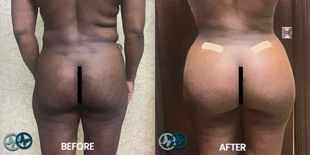 Before and After Skinny BBL_Dr Nees Delray Beach