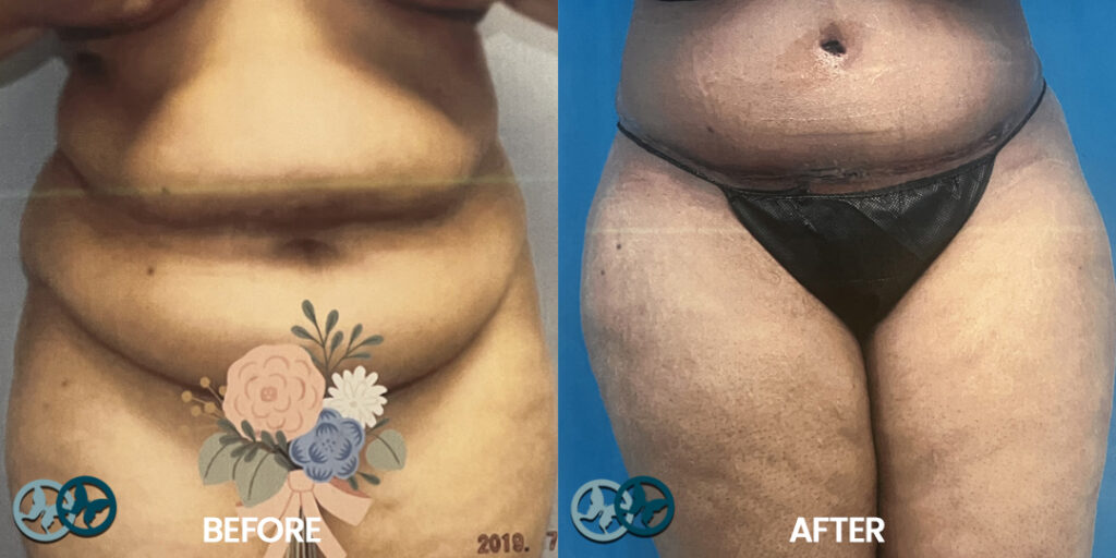 Before and After Tummy Tuck_Dr Nees Delray Beach