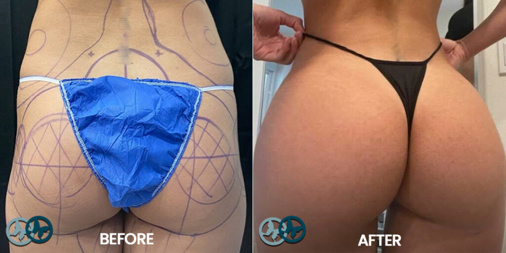 Brazilian Butt Lift Delray Beach_Dr Nees Plastic Surgery