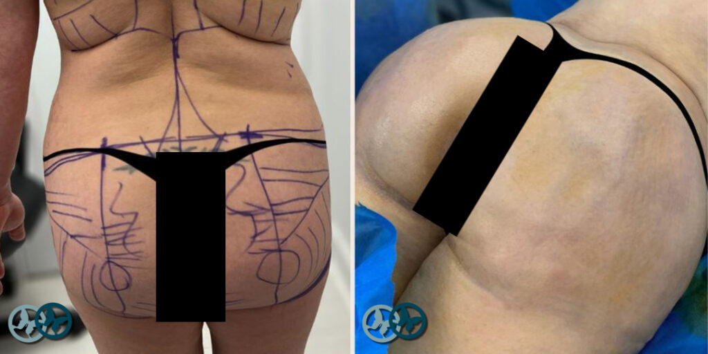 Brazilian Butt Lift, Liposuction_Dr Nees Delray Beach