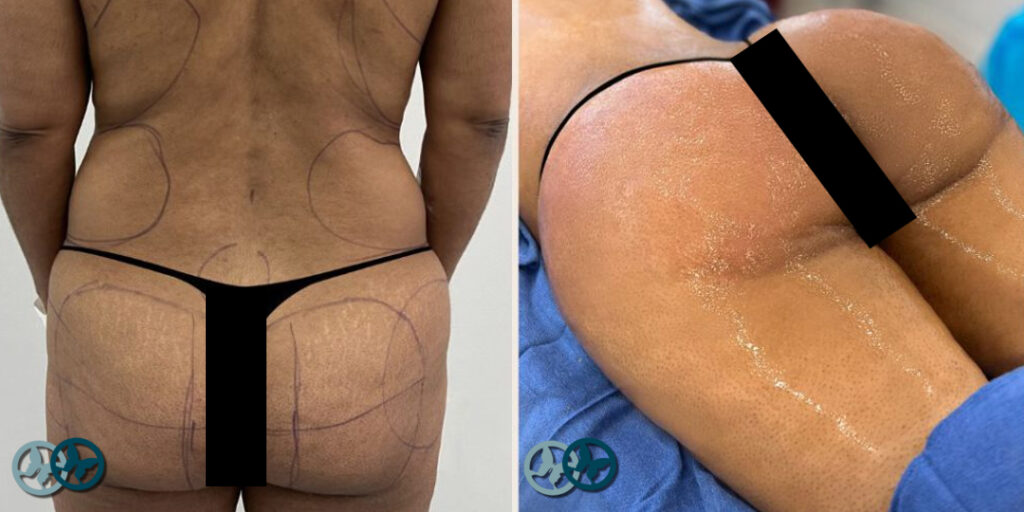 Brazilian Butt Lift_Dr Nees Delray Beach