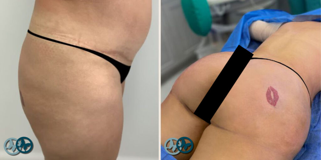 Brazilian Butt Lift_Dr Nees Delray Beach