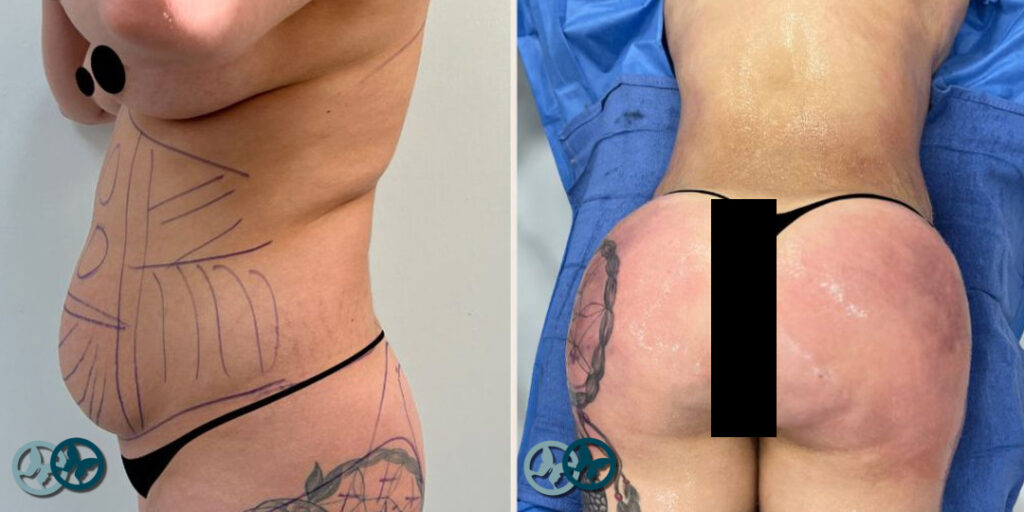 Brazilian Butt Lift, Liposuction_Dr Nees Delray Beach